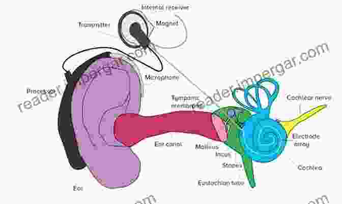 Diagram Of A Cochlear Implant Made To Hear: Cochlear Implants And Raising Deaf Children (A Quadrant Book)