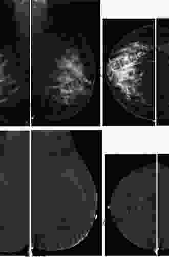 Contrast Enhanced Mammography Kristina Benson